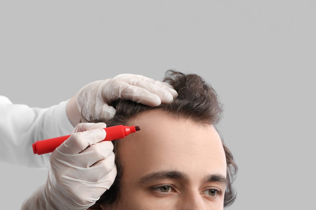 hair transplant turkey cost